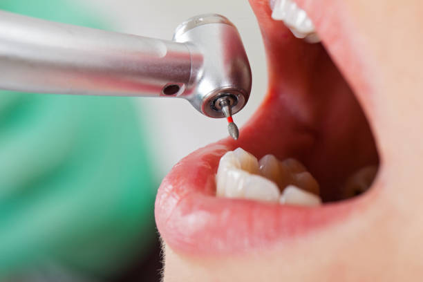 Best Urgent Care for Lost Fillings or Crowns in Oxnard, CA